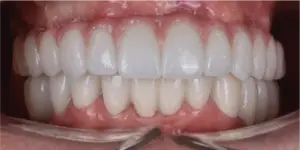 After Treatment Photo