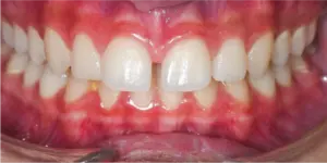 Before Treatment Photo