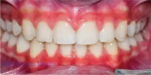 After Treatment Photo