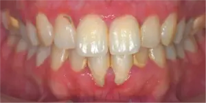 Before Treatment Photo