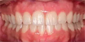 After Treatment Photo