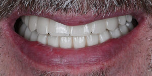 After Treatment Photo