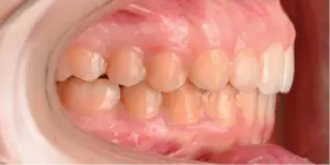After Treatment Photo