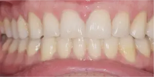 After Treatment Photo