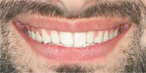 After Treatment Photo