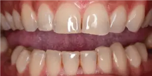 Before Treatment Photo