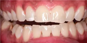After Treatment Photo