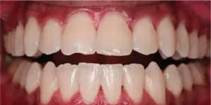 After Treatment Photo
