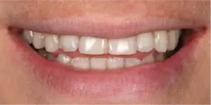 Before Treatment Photo