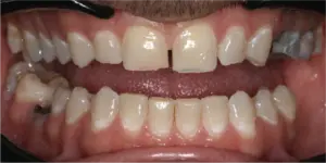 Before Treatment Photo