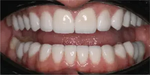 After Treatment Photo