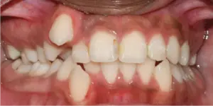 Before Treatment Photo