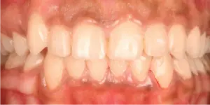 After Treatment Photo