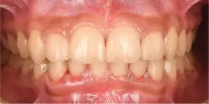 After Treatment Photo