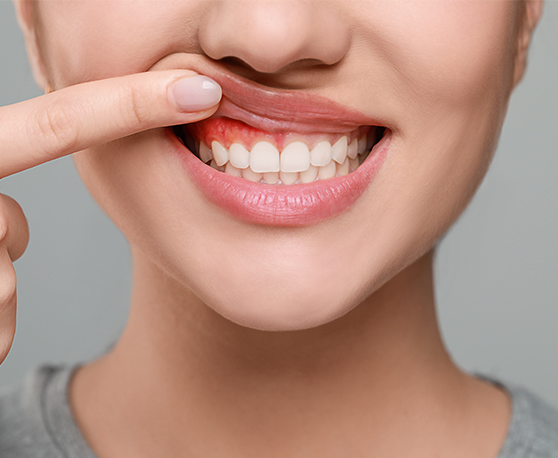 img-gum-disease