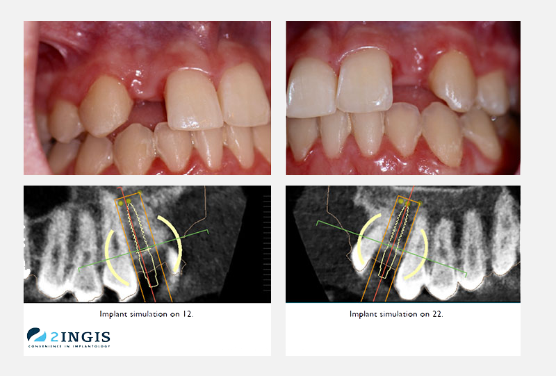 3d-dental-implant-graph