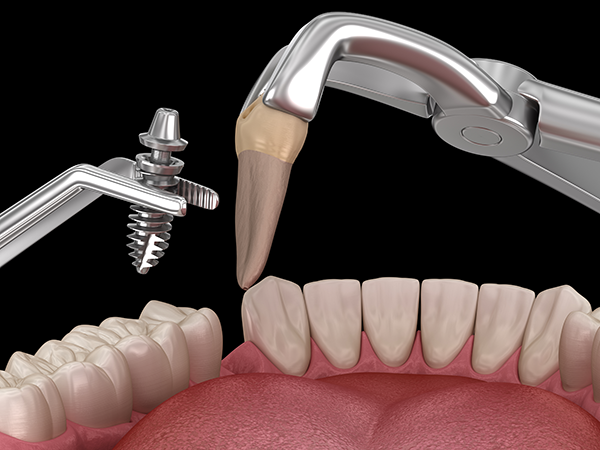 img-immediate-implants