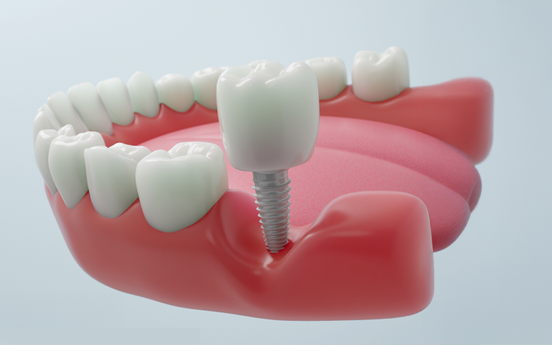 img-ceramic-implant-v1