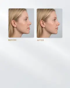 Orthognathic Surgery